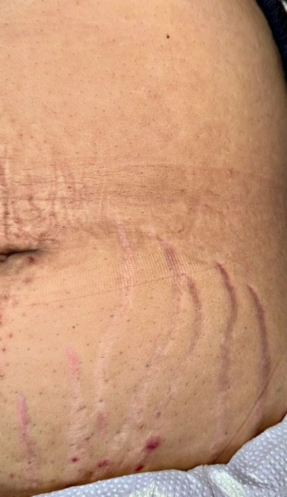 Abdômen inferior antes e depois do tratamento de estrias com MicroPercut — antes