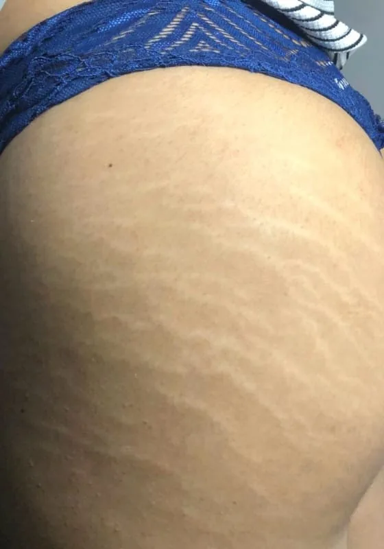 Glúteos antes e depois do tratamento de estrias com MicroPercut — antes